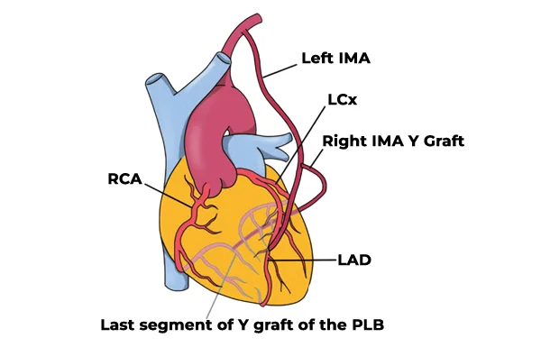 Off Pump Beating Heart Coronary Bypass
